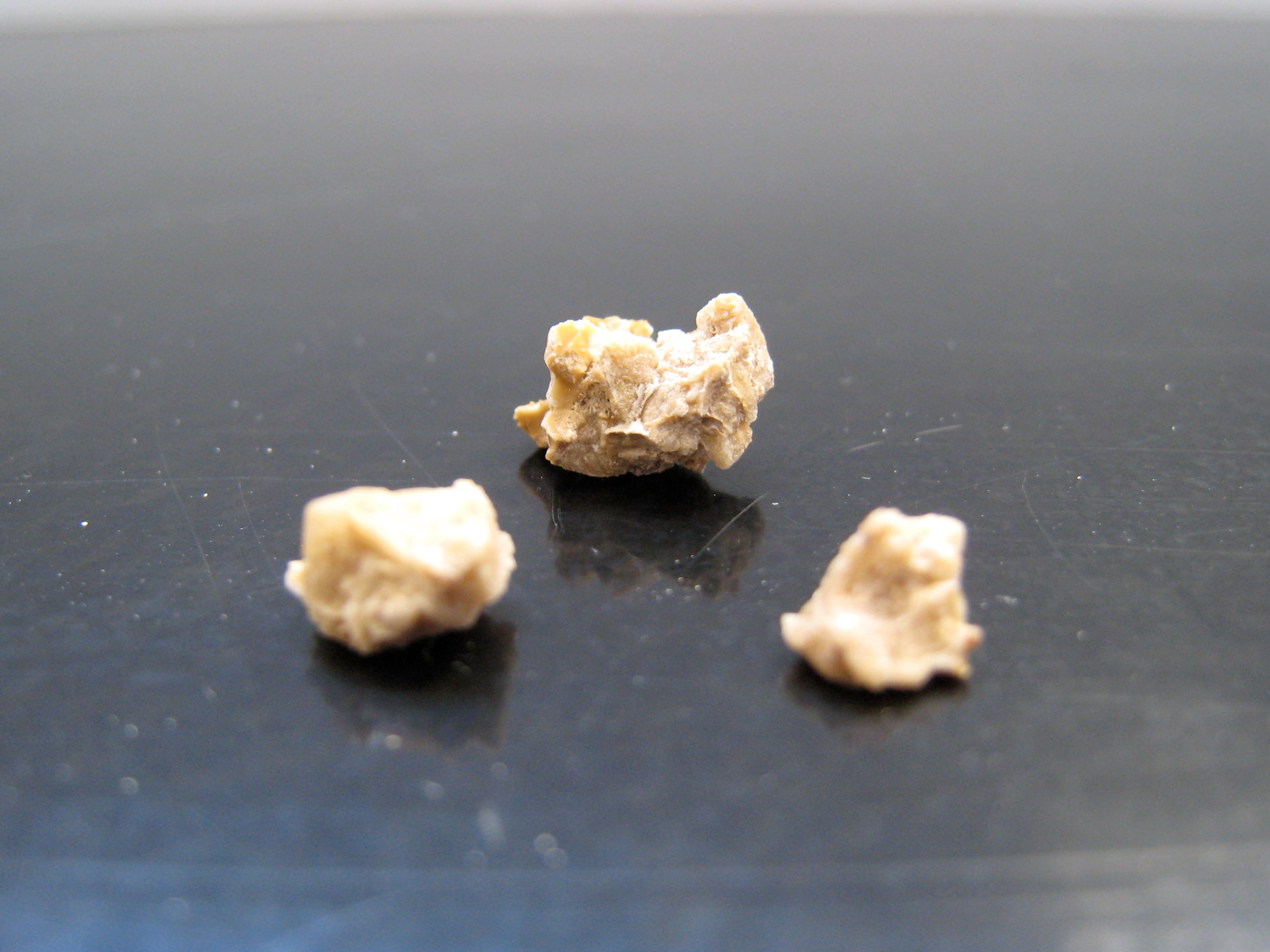 Kidney stones