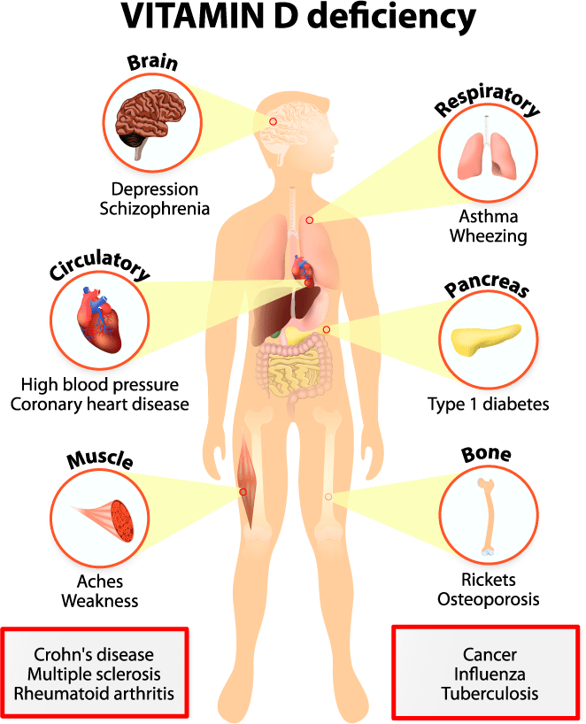 vitamin D deficiency